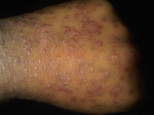 black rash on skin #10