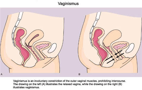 Vulvodynia | Health | Embarrassing | Channel4.com/bodies