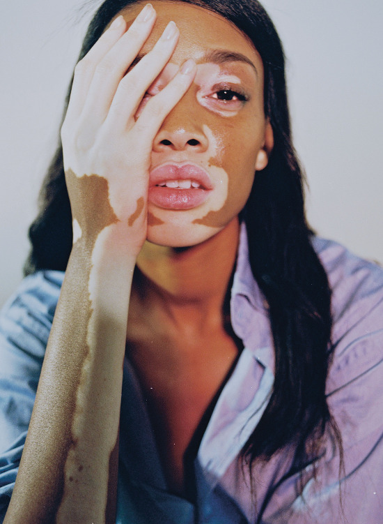 Ex-America's Top Model Hopeful with Vitiligo Chantelle Winnie Poses for i-D Magazine Shares Backlash Experience | BellaNaija