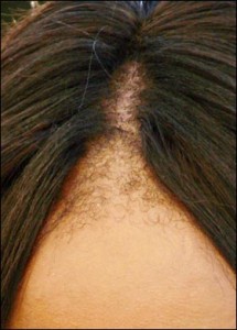 Naomi Campbell's Hairline