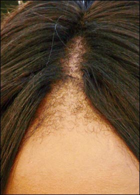 Naomi Campbell's Hairline