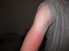 Sunburnt arm
