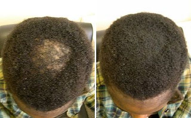 A Quick Fix for Your Bald Spots & Damaged Hairline - Super Million Hair