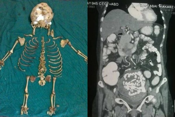 Baby Skeleton - August 2014 - BN News - BellaNaija.com 01