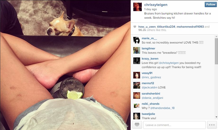 Stretchies Say Hi Chrissy Teigen Shows Off Her Stretch Marks And Bruises On Social Media