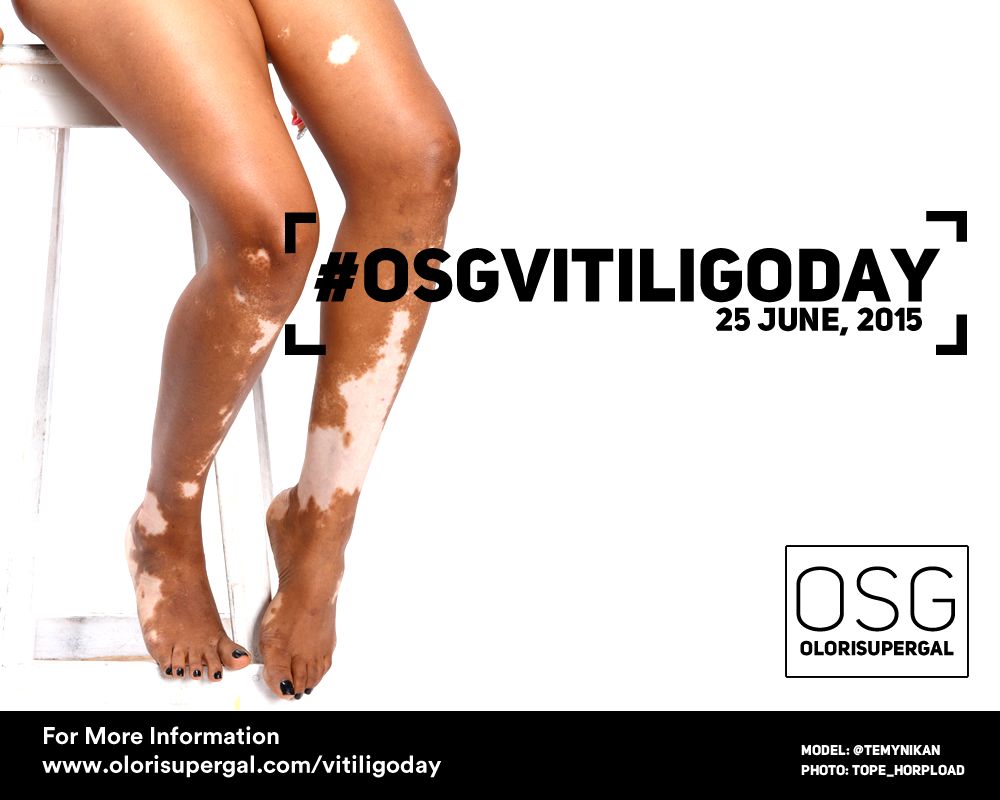 OSGVitiligoDay by Tosin Ajibade of Olori SuperGal - BellaNaija - June2015001 (9)