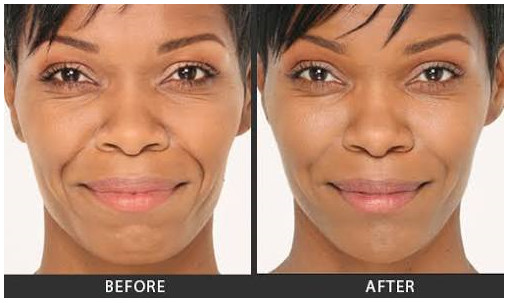 Want to get rid of those wrinkles and fine lines without lying on