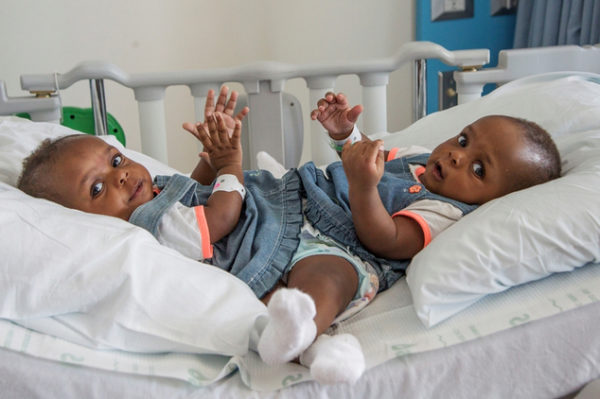 Conjoined Ayeni Twins Separated in U.S 