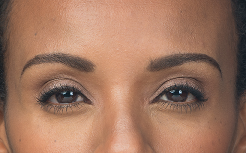 botox-after-2