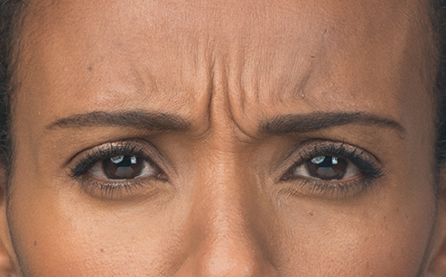 botox-before-1
