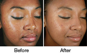 chemical-peels