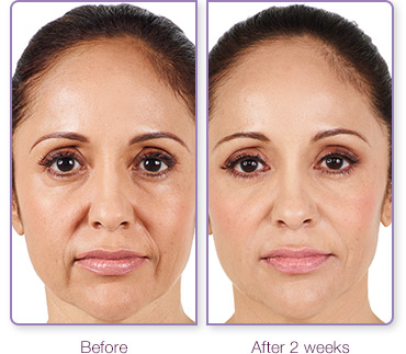 derma-fillers-1