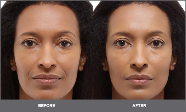 derma-fillers-2