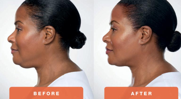 kybella