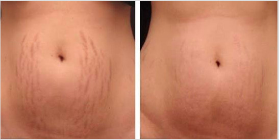 microneedling-1