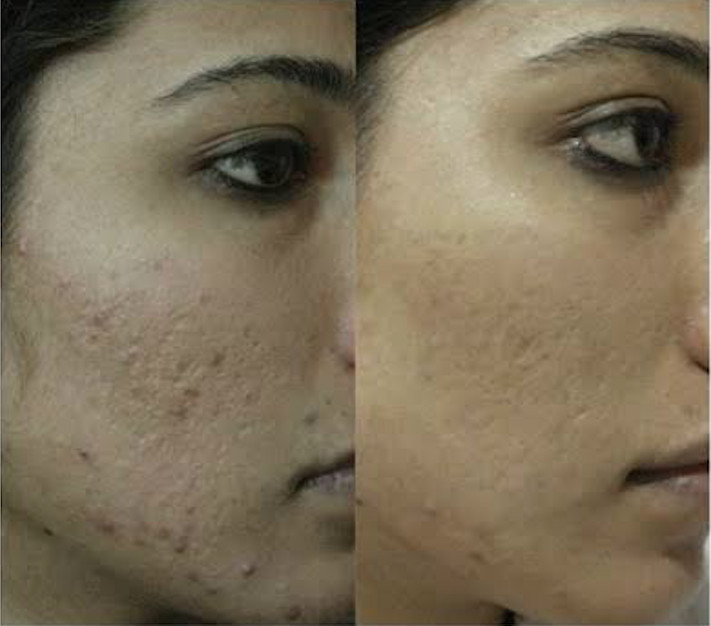 microneedling-2