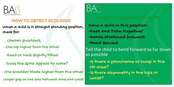 scoliosis