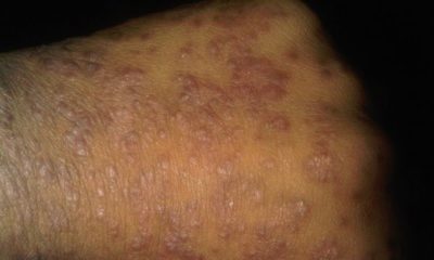 Psoriasis