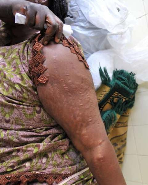 bleaching stretch marks