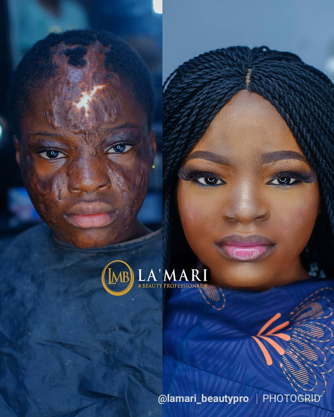 This Burn Victim's transformation will Warm Your Hearts ?